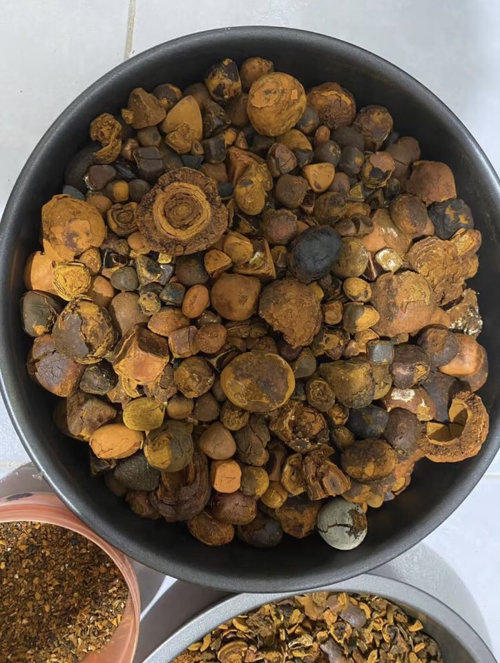 gallstones for sale